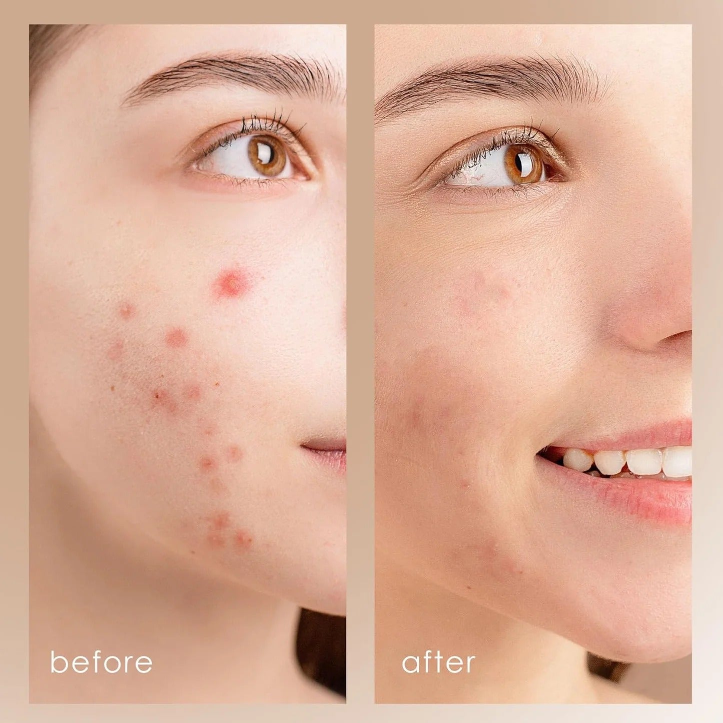 Peeling Limpiador de Poros con Vibración